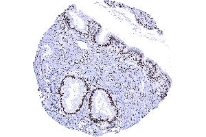 Uterus endocervix Strong PR immunostaining in epithelial and stromal cells of the endocervix (Recombinant Progesterone Receptor anticorps  (AA 1-200))