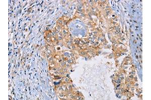 The image on the left is immunohistochemistry of paraffin-embedded Human cervical cancer tissue using ABIN7192619(SPAG6 Antibody) at dilution 1/30, on the right is treated with synthetic peptide. (SPAG6 anticorps)