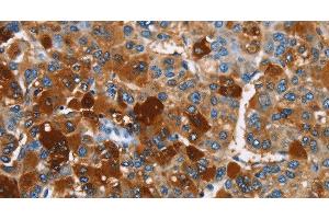 Immunohistochemistry of paraffin-embedded Human liver cancer using ARMCX2 Polyclonal Antibody at dilution of 1:40 (ARMCX2 anticorps)