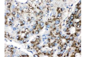Catalase was detected in paraffin-embedded sections of human liver cancer tissues using rabbit anti- Catalase Antigen Affinity purified polyclonal antibody (Catalog # ) at 1 µg/mL. (Catalase anticorps  (AA 344-527))