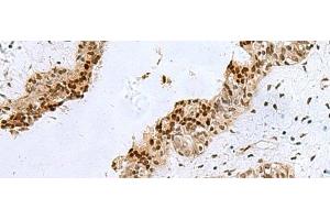 Immunohistochemistry of paraffin-embedded Human breast cancer tissue using H2AFJ Polyclonal Antibody at dilution of 1:170(x200) (H2AFJ anticorps)