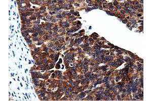 Immunohistochemical staining of paraffin-embedded Adenocarcinoma of Human colon tissue using anti-CBWD1 mouse monoclonal antibody. (CBWD1 anticorps)