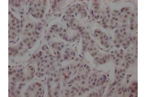 IHC image of ABIN7127371 diluted at 1:100 and staining in paraffin-embedded human breast cancer performed on a Leica BondTM system.