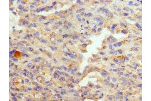 Immunohistochemistry of paraffin-embedded human melanoma using ABIN7152009 at dilution of 1:100 (GATA1 anticorps  (AA 39-153))