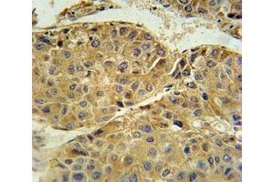 Beta III Tubulin antibody immunohistochemistry analysis in formalin fixed and paraffin embedded human hepatocarcinoma.