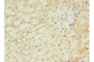 Immunohistochemistry of paraffin-embedded human liver cancer using ABIN7144167 at dilution of 1:100 (ANKMY2 anticorps  (AA 1-280))