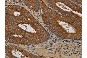 The image on the left is immunohistochemistry of paraffin-embedded Human colon cancer tissue using ABIN7129963(KCNK17 Antibody) at dilution 1/60, on the right is treated with fusion protein. (KCNK17 anticorps)