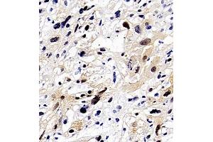 Immunohistochemistry of paraffin embedded human liver cancer using Api5 (ABIN7073094) at dilution of 1:350 (400x lens)