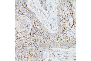 Immunohistochemistry of paraffin-embedded human lung squamous carcinoma tissue using THBD Rabbit pAb (ABIN1683026, ABIN3018621, ABIN3018622 and ABIN6220518) at dilution of 1:25 (40x lens).