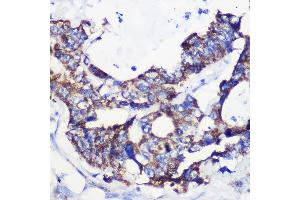 Immunohistochemistry of paraffin-embedded Human colon carcinoma using  Rabbit pAb (ABIN7265426) at dilution of 1:100 (40x lens).