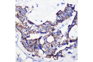 Immunohistochemistry of paraffin-embedded Human colon carcinoma using  Rabbit pAb (ABIN7265426) at dilution of 1:100 (40x lens). (ACSS1 anticorps  (AA 340-689))