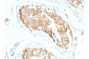 Formalin-fixed, paraffin-embedded human Testicular Carcinoma stained with ALDH1A1 Mouse Monoclonal Antibody (ALDH1A1/1381).