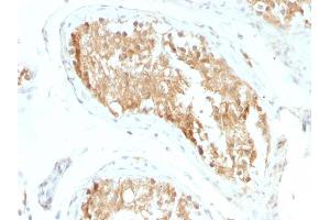 Formalin-fixed, paraffin-embedded human Testicular Carcinoma stained with ALDH1A1 Mouse Monoclonal Antibody (ALDH1A1/1381). (ALDH1A1 anticorps  (AA 315-434))