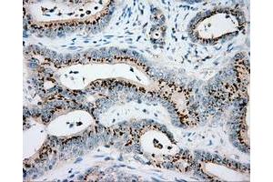 Immunohistochemical staining of paraffin-embedded Adenocarcinoma of colon tissue using anti-VAT1L mouse monoclonal antibody. (VAT1L anticorps)