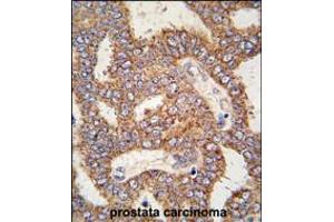 Formalin-fixed and paraffin-embedded human prostata carcinoma tissue reacted with TRPM8 antibody , which was peroxidase-conjugated to the secondary antibody, followed by DAB staining.