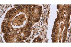 Immunohistochemistry of paraffin-embedded Human colon cancer tissue using EXTL3 Polyclonal Antibody at dilution 1:30 (EXTL3 anticorps)