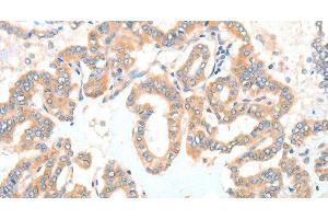 Immunohistochemistry of paraffin-embedded Human thyroid cancer tissue using ADCK1 Polyclonal Antibody at dilution 1:40 (ADCK1 anticorps)