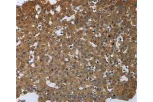 Immunohistochemistry of Human lung cancer using PTPRM Polyclonal Antibody at dilution of 1:40 (PTPRM anticorps)