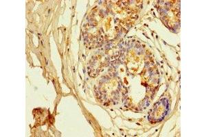 Immunohistochemistry of paraffin-embedded human breast cancer using ABIN7163953 at dilution of 1:100 (Kv1.6/KCNA6 anticorps  (AA 1-171))