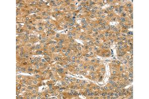 Immunohistochemistry of Human esophagus cancer using RASSF9 Polyclonal Antibody at dilution of 1:45 (RASSF9 anticorps)