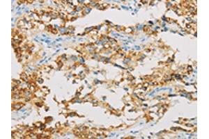 The image on the left is immunohistochemistry of paraffin-embedded Human thyroid cancer tissue using ABIN7129804(IDH3B Antibody) at dilution 1/30, on the right is treated with fusion protein. (IDH3B anticorps)
