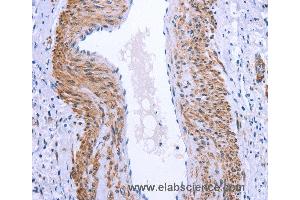 Immunohistochemistry of Human cervical cancer using GPR171 Polyclonal Antibody at dilution of 1:25 (GPR171 anticorps)