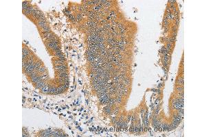 Immunohistochemistry of Human liver cancer using ARHGAP5 Polyclonal Antibody at dilution of 1:30 (ARHGAP5 anticorps)