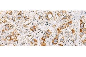 Immunohistochemistry of paraffin-embedded Human liver cancer tissue using MMAB Polyclonal Antibody at dilution of 1:65(x200) (MMAB anticorps)