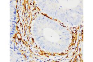 Anti-Galectin 1 antibody, IHC(P) IHC(P): Human Intestinal Cancer Tissue (LGALS1/Galectin 1 anticorps  (C-Term))