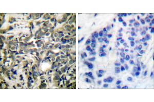 P-peptide - +Immunohistochemical analysis of paraffin-embedded human breast carcinoma tissue using 14-3-3 ζ (phospho-Ser58) antibody. (14-3-3 zeta anticorps  (pSer58))