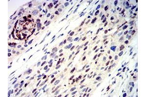 Immunohistochemical analysis of paraffin-embedded esophageal cancer tissues using TFAP2C mouse mAb with DAB staining.