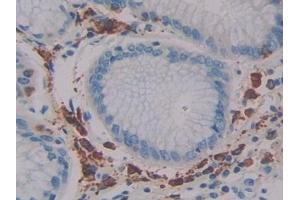 Detection of LAT2 in Human Stomach cancer Tissue using Polyclonal Antibody to Linker For Activation Of T-Cells Family, Member 2 (LAT2)