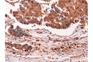 Detection of Ub in Human Liver cancer Tissue using Monoclonal Antibody to Ubiquitin (Ub)