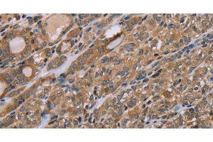 Immunohistochemistry of paraffin-embedded Human thyroid cancer tissue using NAA25 Polyclonal Antibody at dilution 1:40 (NAA25 anticorps)