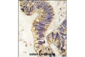 Formalin-fixed and paraffin-embedded human colon carcinoma tissue reacted with SRC1 antibody (C-term) (ABIN391825 and ABIN2841670) , which was peroxidase-conjugated to the secondary antibody, followed by DAB staining.