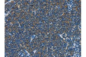 The image on the left is immunohistochemistry of paraffin-embedded Human Lymphoma tissue using ABIN7190319(CNTNAP3 Antibody) at dilution 1/40, on the right is treated with synthetic peptide. (CNTNAP3 anticorps)