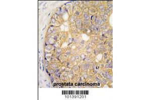 Formalin-fixed and paraffin-embedded human prostata carcinoma tissue reacted with GJB6 Antibody , which was peroxidase-conjugated to the secondary antibody, followed by DAB staining.