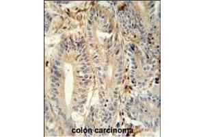 MEP1A antibody (N-term) (ABIN652039 and ABIN2840513) immunohistochemistry analysis in formalin fixed and paraffin embedded human colon carcinoma followed by peroxidase conjugation of the secondary antibody and DAB staining. (MEP1A anticorps  (N-Term))