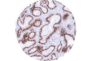 Prostatic adenocarcinoma Gleason 336 with strong granular perinuclear cytoplasmic prostein staining of tumor cells (Recombinant SLC45A3 anticorps  (N-Term))