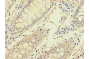 Immunohistochemistry of paraffin-embedded human colon cancer using ABIN7162103 at dilution of 1:100 (MACROD1 anticorps  (AA 83-325))