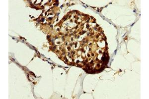 IHC image of ABIN7154867 diluted at 1:200 and staining in paraffin-embedded human breast cancer performed on a Leica BondTM system.