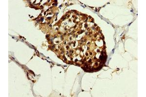 IHC image of ABIN7154867 diluted at 1:200 and staining in paraffin-embedded human breast cancer performed on a Leica BondTM system. (HSP70 1A anticorps  (AA 418-512))