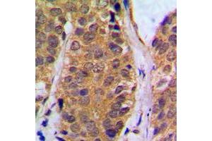 Immunohistochemical analysis of NF-kappaB p105 (pS927) staining in human breast cancer formalin fixed paraffin embedded tissue section. (NFKB1 anticorps  (C-Term, pSer927))