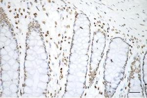 Immunohistochemistry was performed on paraffin-embedded human sigmoid colon carcinoma using histone H3 (di methyl K4) antibody (ABIN7798955), 1:200). (Recombinant Histone 3 anticorps  (H3K4me2))