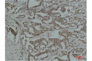 Immunohistochemical analysis of paraffin-embedded Human Breast Carcinoma using Acetyl Lysine Monoclonal Antibody. (Acetylated Lysine anticorps)