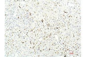 Immunohistochemical analysis of paraffin-embedded Human Breast Carcinoma Tissue using JAK1 Mouse mAb diluted at 1:200. (JAK1 anticorps  (AA 960-1040))