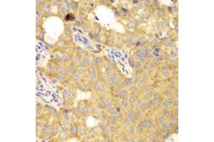 Immunohistochemistry of paraffin-embedded human oophoroma using GNB2L1 antibody (ABIN6292956) at dilution of 1:100 (40x lens).