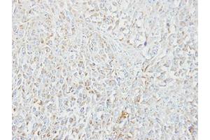 IHC-P Image Immunohistochemical analysis of paraffin-embedded CL1-5 xenograft, using MIPEP, antibody at 1:100 dilution. (MIPEP anticorps)