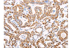 The image on the left is immunohistochemistry of paraffin-embedded Human thyroid cancer tissue using ABIN7128594(ATPIF1 Antibody) at dilution 1/50, on the right is treated with fusion protein.