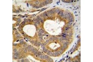 TRPM8 antibody immunohistochemistry analysis in formalin fixed and paraffin embedded human prostate carcinoma.
